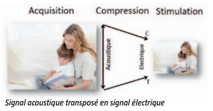Schéma du fonctionnement de l'implant : acquisition, compression et stimulation, le signal acoustique transposé en signal électrique